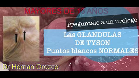 que son las glandulas tyson|¿Por qué salen las glándulas de Tyson o bolitas。